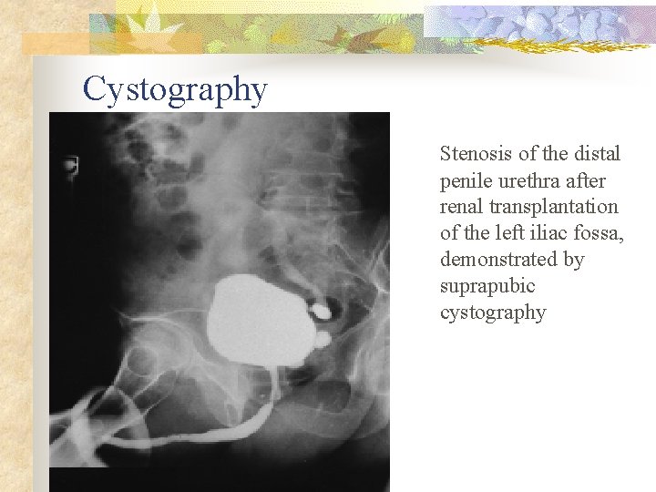 Cystography Stenosis of the distal penile urethra after renal transplantation of the left iliac