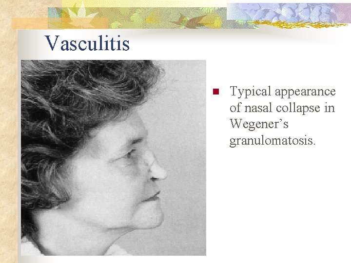Vasculitis n Typical appearance of nasal collapse in Wegener’s granulomatosis. 