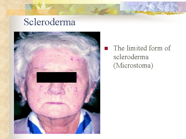 Scleroderma n The limited form of scleroderma (Microstoma) 