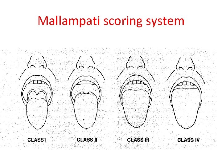 Mallampati scoring system 