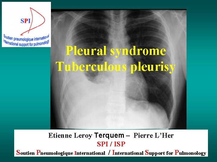 Pleural syndrome Tuberculous pleurisy Etienne Leroy Terquem – Pierre L’Her SPI / ISP Soutien
