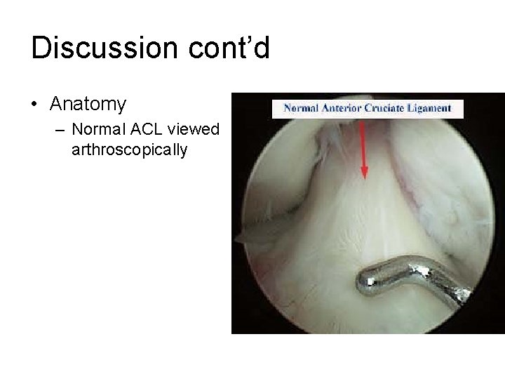 Discussion cont’d • Anatomy – Normal ACL viewed arthroscopically 