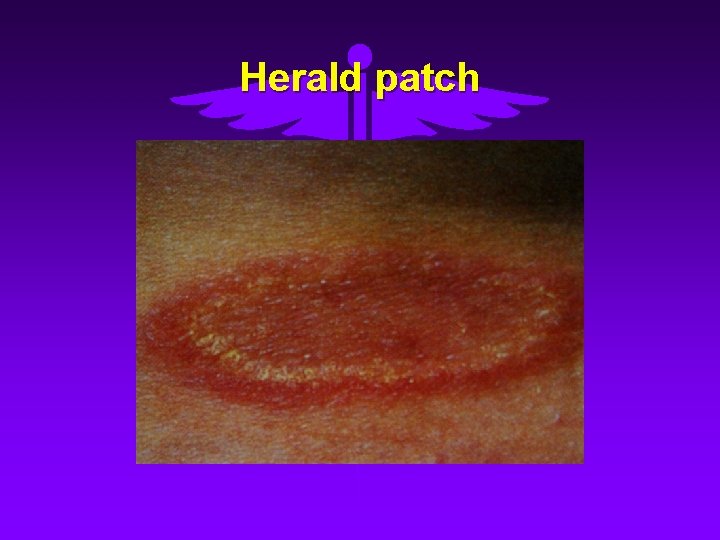 Herald patch 