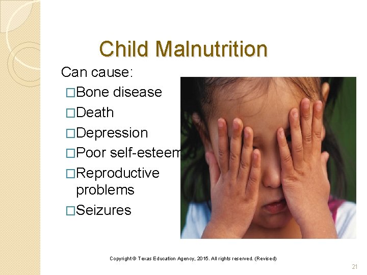 Child Malnutrition Can cause: �Bone disease �Death �Depression �Poor self-esteem �Reproductive problems �Seizures Copyright