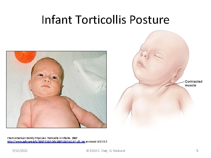 Infant Torticollis Posture From American Family Physician. Torticollis in Infants. 2007 http: //www. aafp.