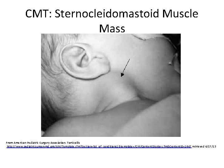 CMT: Sternocleidomastoid Muscle Mass From American Pediatric Surgery Association. Torticollis http: //www. pediatricsurgerymd. org/AM/Template.