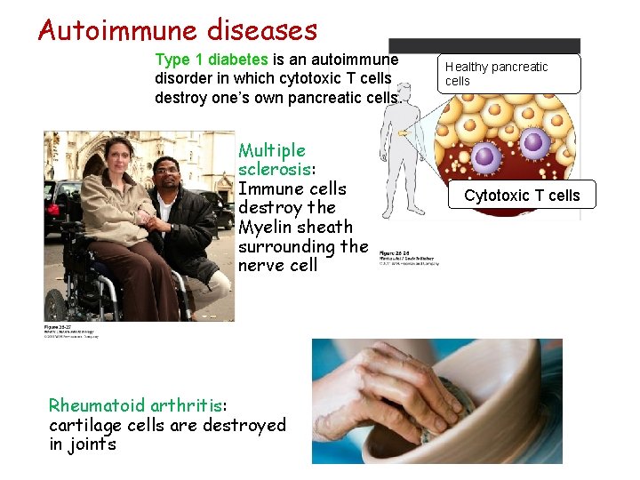 Autoimmune diseases Type 1 diabetes is an autoimmune disorder in which cytotoxic T cells