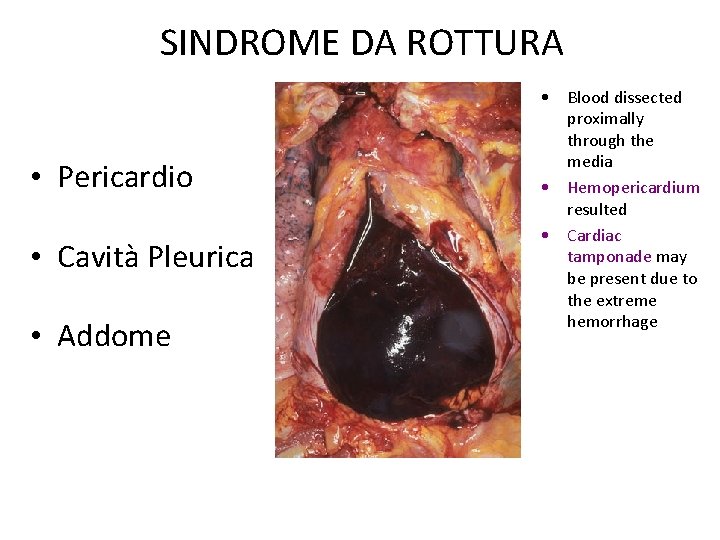 SINDROME DA ROTTURA • Pericardio • Cavità Pleurica • Addome • Blood dissected proximally
