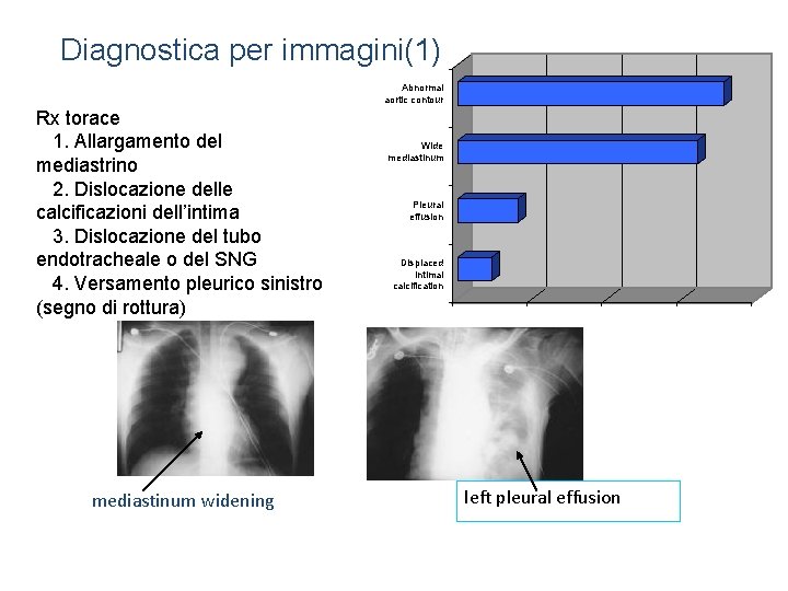Diagnostica per immagini(1) Abnormal aortic contour Rx torace Chest X-Ray Findings 1. Allargamento del