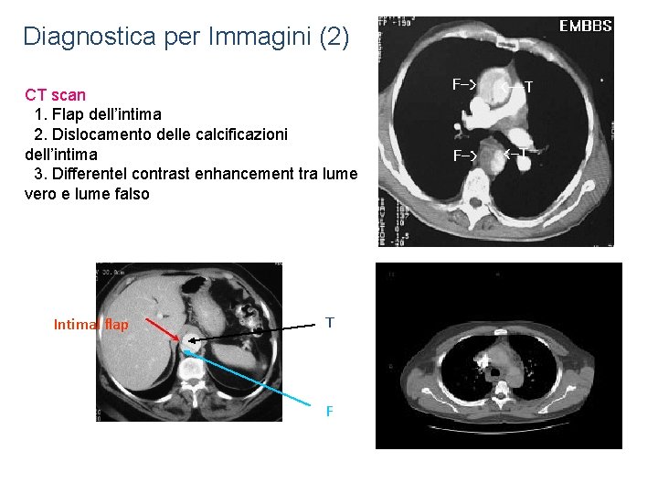 Diagnostica per Immagini (2) CT scan 1. Flap dell’intima 2. Dislocamento delle calcificazioni dell’intima