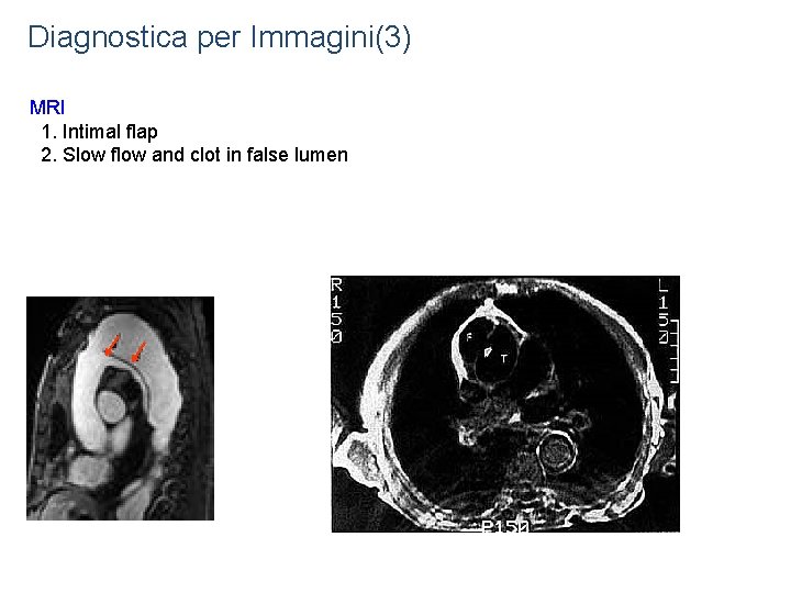 Diagnostica per Immagini(3) MRI 1. Intimal flap 2. Slow flow and clot in false