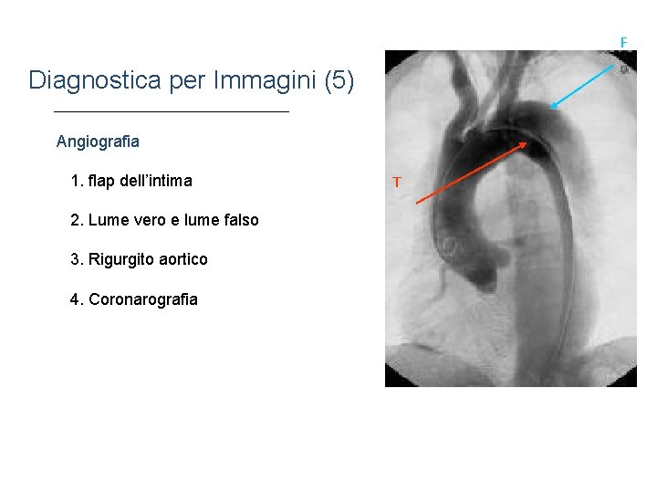 F Diagnostica per Immagini (5) Angiografia 1. flap dell’intima 2. Lume vero e lume