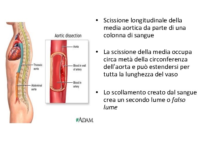  • Scissione longitudinale della media aortica da parte di una colonna di sangue