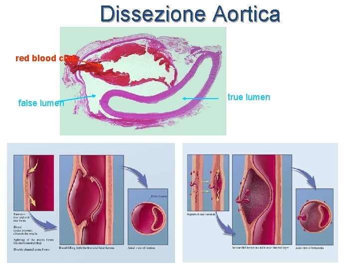 Dissezione Aortica red blood clot false lumen true lumen 