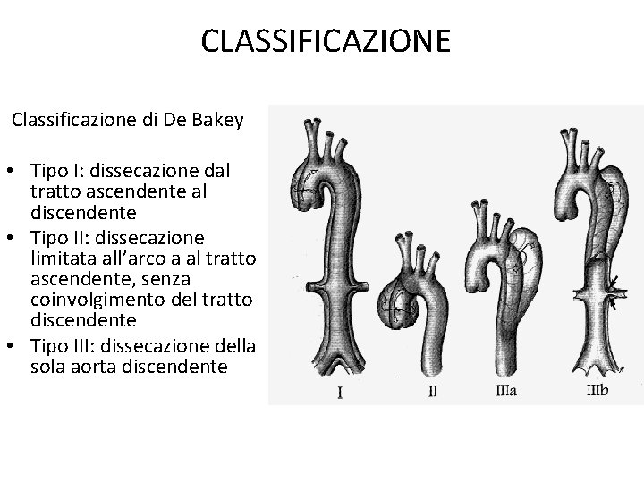 CLASSIFICAZIONE Classificazione di De Bakey • Tipo I: dissecazione dal tratto ascendente al discendente