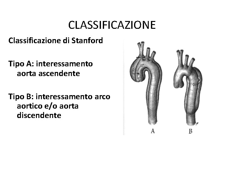 CLASSIFICAZIONE Classificazione di Stanford Tipo A: interessamento aorta ascendente Tipo B: interessamento arco aortico