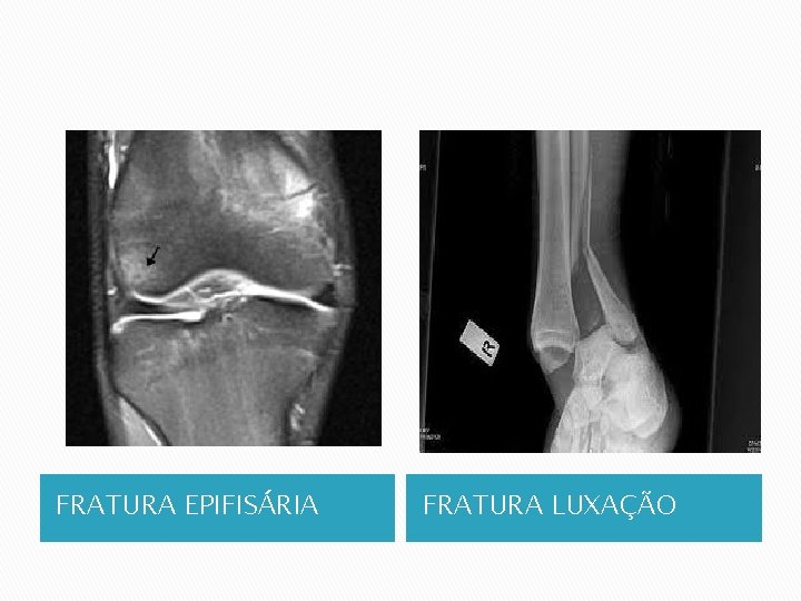 FRATURA EPIFISÁRIA FRATURA LUXAÇÃO 