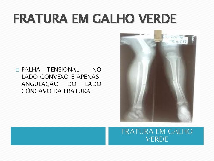 FRATURA EM GALHO VERDE � FALHA TENSIONAL NO LADO CONVEXO E APENAS ANGULAÇÃO DO