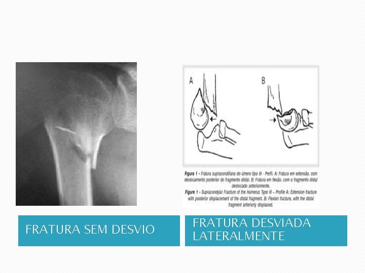 FRATURA SEM DESVIO FRATURA DESVIADA LATERALMENTE 