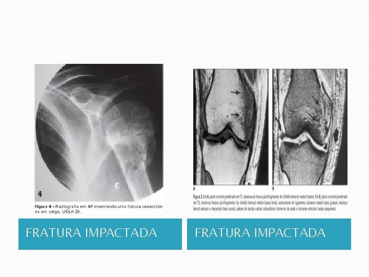 FRATURA IMPACTADA 