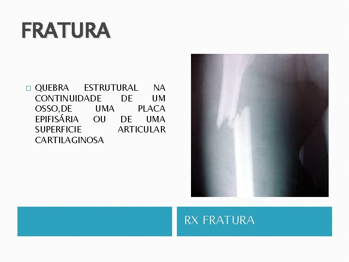 FRATURA � QUEBRA ESTRUTURAL NA CONTINUIDADE DE UM OSSO, DE UMA PLACA EPIFISÁRIA OU