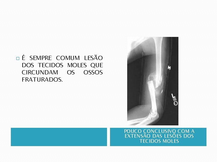 � É SEMPRE COMUM LESÃO DOS TECIDOS MOLES QUE CIRCUNDAM OS OSSOS FRATURADOS. POUCO