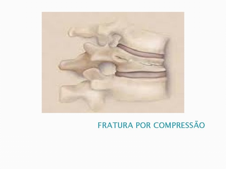 FRATURA POR COMPRESSÃO 