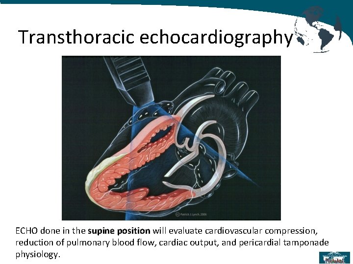 Transthoracic echocardiography ECHO done in the supine position will evaluate cardiovascular compression, reduction of
