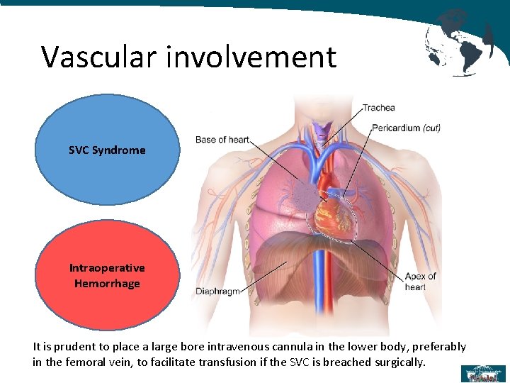 Vascular involvement SVC Syndrome Intraoperative Hemorrhage It is prudent to place a large bore