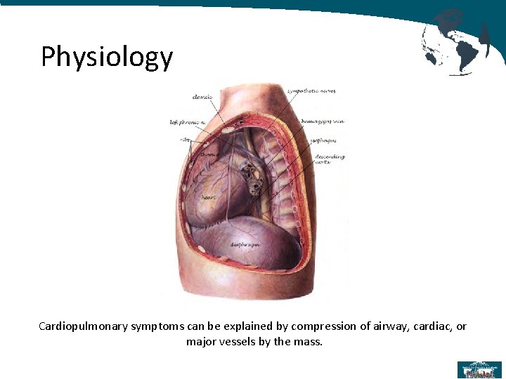 Physiology Cardiopulmonary symptoms can be explained by compression of airway, cardiac, or major vessels