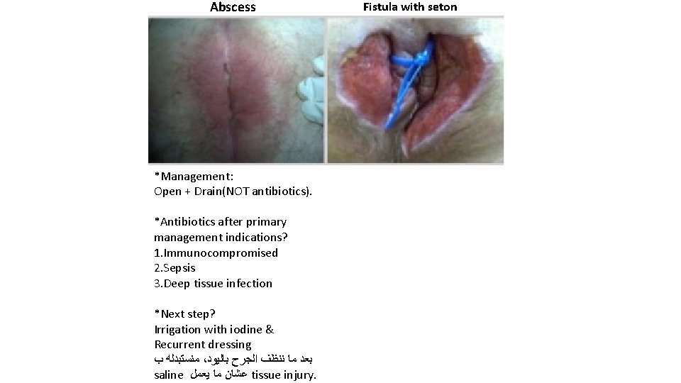 Abscess *Management: Open + Drain(NOT antibiotics). *Antibiotics after primary management indications? 1. Immunocompromised 2.