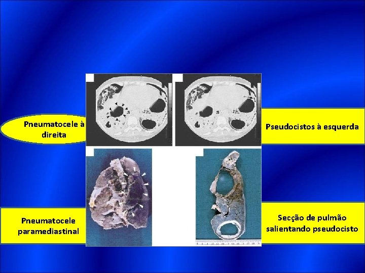 Pneumatocele à direita Pneumatocele paramediastinal Pseudocistos à esquerda Secção de pulmão salientando pseudocisto 