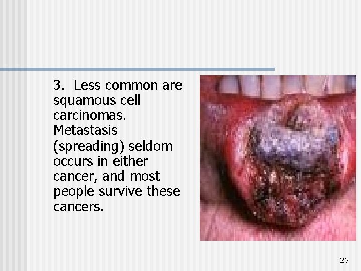 3. Less common are squamous cell carcinomas. Metastasis (spreading) seldom occurs in either cancer,