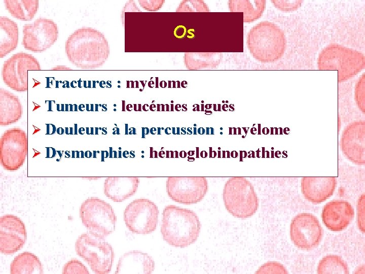Os Ø Fractures : myélome Ø Tumeurs : leucémies aiguës Ø Douleurs à la