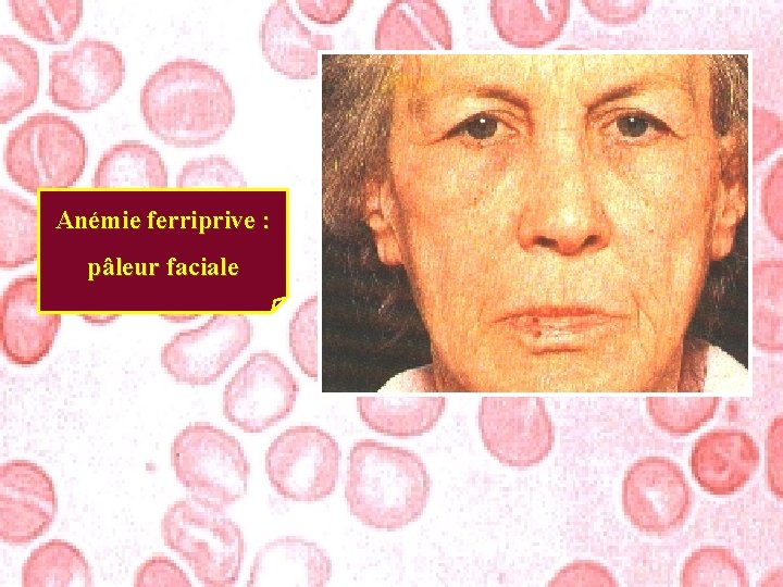 Anémie ferriprive : pâleur faciale 