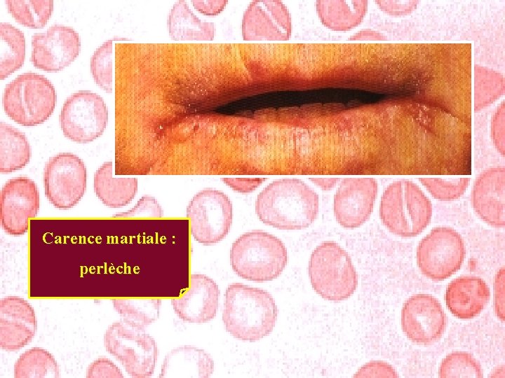 Carence martiale : perlèche 