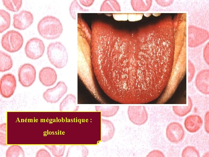 Anémie mégaloblastique : glossite 