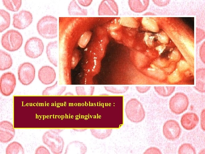 Leucémie aiguë monoblastique : hypertrophie gingivale 