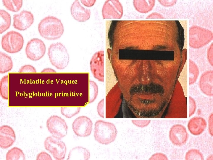 Maladie de Vaquez Polyglobulie primitive 