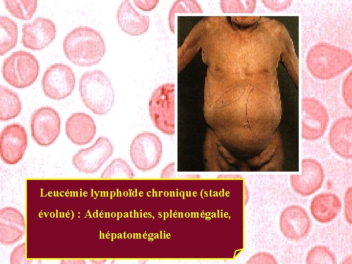 Leucémie lymphoïde chronique (stade évolué) : Adénopathies, splénomégalie, hépatomégalie 