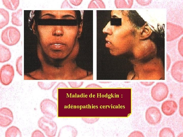 Maladie de Hodgkin : adénopathies cervicales 