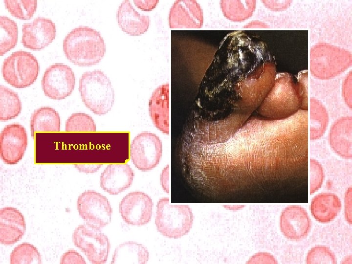Thrombose 