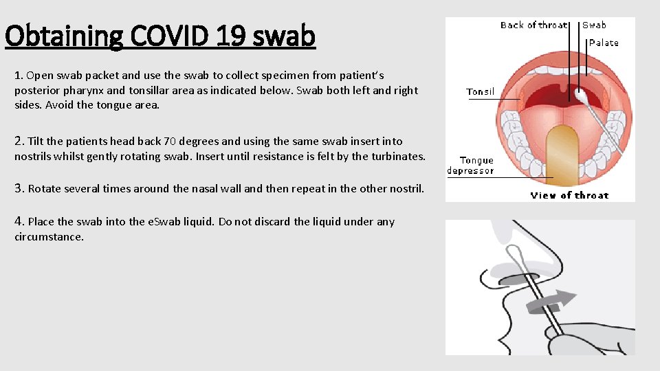 Obtaining COVID 19 swab 1. Open swab packet and use the swab to collect