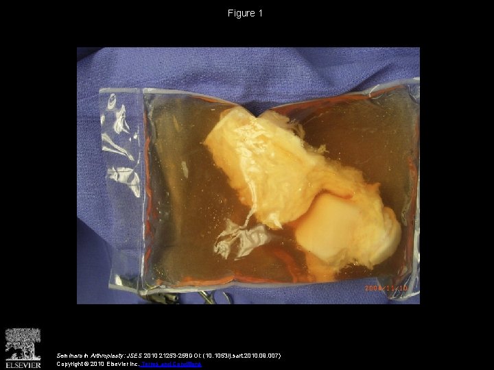 Figure 1 Seminars in Arthroplasty: JSES 2010 21253 -258 DOI: (10. 1053/j. sart. 2010.