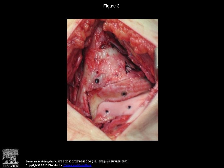 Figure 3 Seminars in Arthroplasty: JSES 2010 21253 -258 DOI: (10. 1053/j. sart. 2010.