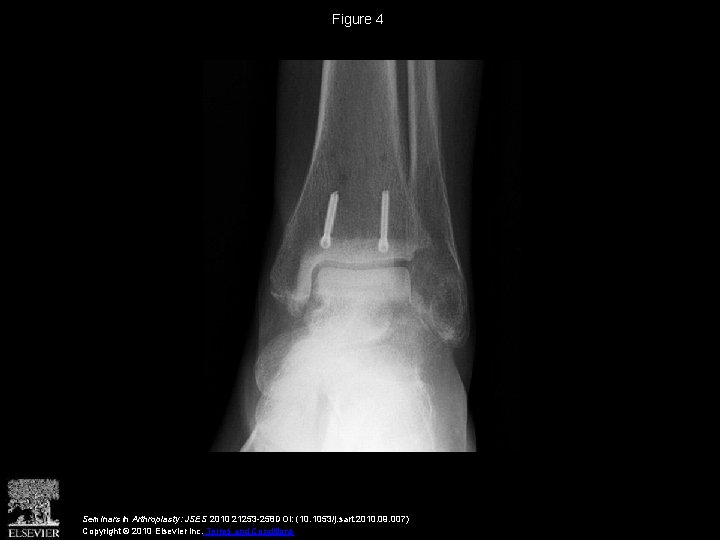 Figure 4 Seminars in Arthroplasty: JSES 2010 21253 -258 DOI: (10. 1053/j. sart. 2010.