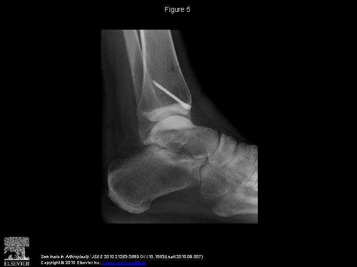 Figure 5 Seminars in Arthroplasty: JSES 2010 21253 -258 DOI: (10. 1053/j. sart. 2010.