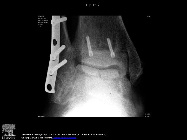 Figure 7 Seminars in Arthroplasty: JSES 2010 21253 -258 DOI: (10. 1053/j. sart. 2010.