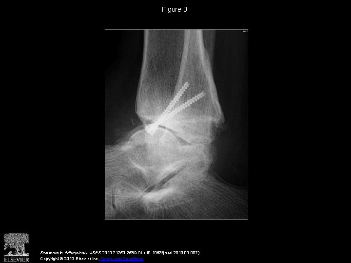 Figure 8 Seminars in Arthroplasty: JSES 2010 21253 -258 DOI: (10. 1053/j. sart. 2010.