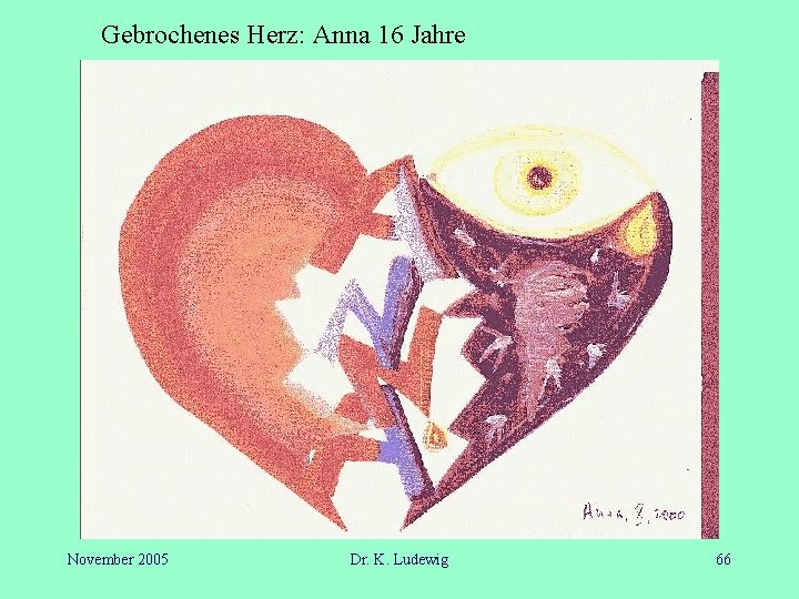 Gebrochenes Herz: Anna 16 Jahre November 2005 Dr. K. Ludewig 66 